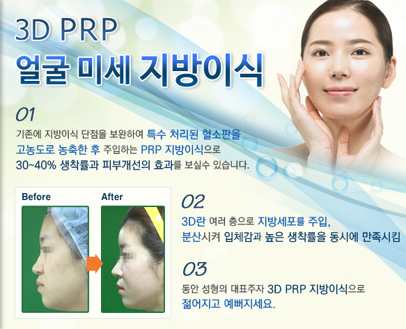 3D PRP  ̼ ̽ 01. ̽  Ͽ Ưó  󵵷   ϴ PRP ̽ 30~40%  Ǻΰ ȿ   ֽϴ. 02.3D   漼 , л ü   ÿ  Ŵ 03.  ǥ 3D PRP̽  .